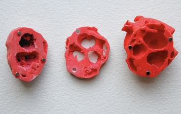 芝加哥大学医学院迎来心脏移植手术里程碑