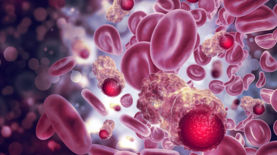 通过综合护理改善成人淋巴细胞白血病预后