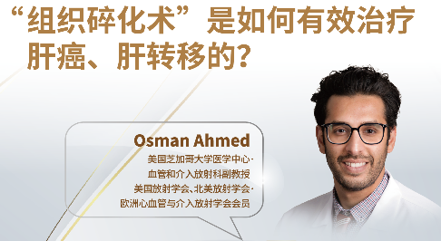 直播：组织碎化术治疗肝癌、肝转移