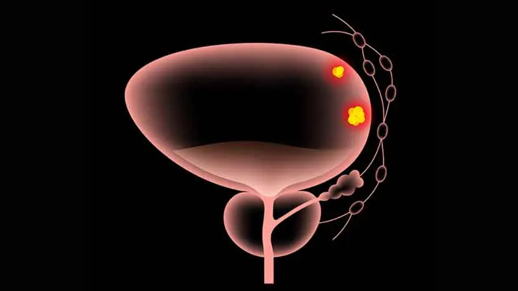 新型联合治疗为晚期膀胱癌患者带来希望