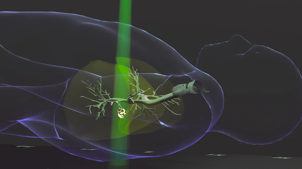 研究揭示大剂量放射治疗有意外副作用