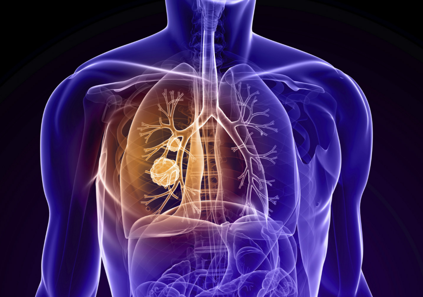 芝加哥大学医学中心多种方法改善肺癌患者预后